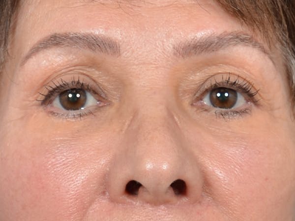 Eyelid Lift Before & After Gallery - Patient 141138438 - Image 2