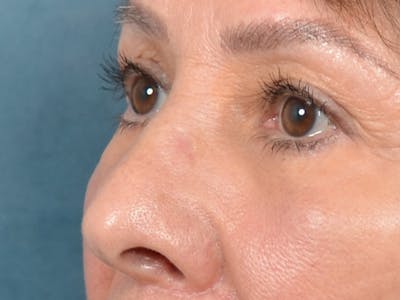 Eyelid Lift Gallery - Patient 141138438 - Image 4