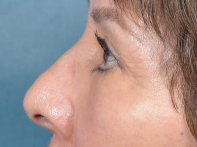Eyelid Lift Gallery - Patient 141138438 - Image 6