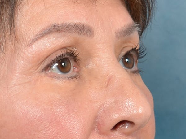 Eyelid Lift Before & After Gallery - Patient 141138438 - Image 10