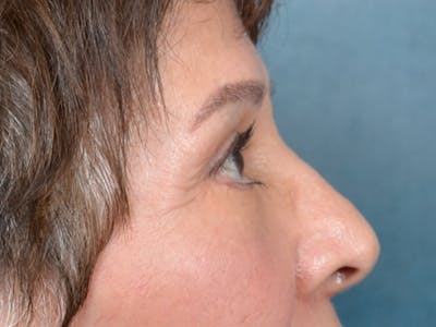 Eyelid Lift Before & After Gallery - Patient 141138438 - Image 8