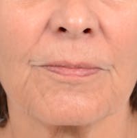 Lip Lift Before & After Gallery - Patient 141138492 - Image 1