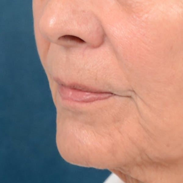 Lip Lift Before & After Gallery - Patient 141138492 - Image 3
