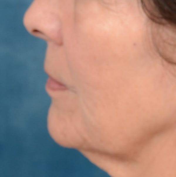 Lip Lift Before & After Gallery - Patient 141138492 - Image 5