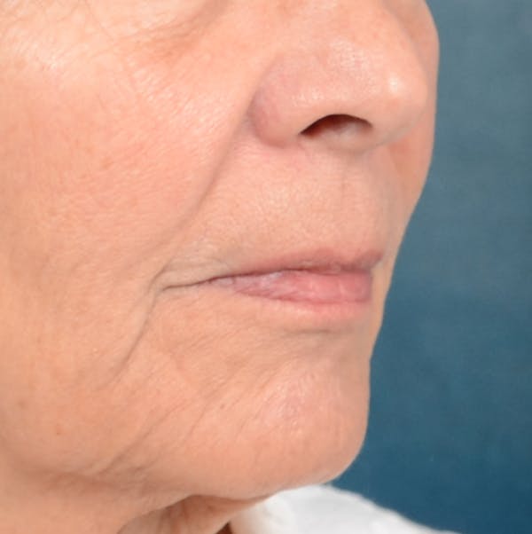 Lip Lift Before & After Gallery - Patient 141138492 - Image 7