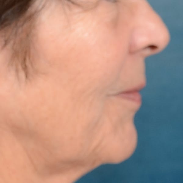 Lip Lift Before & After Gallery - Patient 141138492 - Image 9