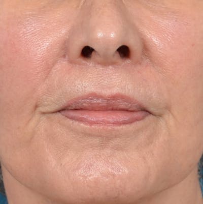 Lip Lift Before & After Gallery - Patient 141138492 - Image 2
