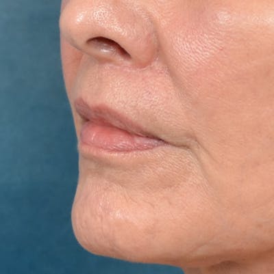 Lip Lift Before & After Gallery - Patient 141138492 - Image 4