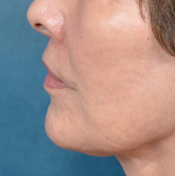 Lip Lift Before & After Gallery - Patient 141138492 - Image 6