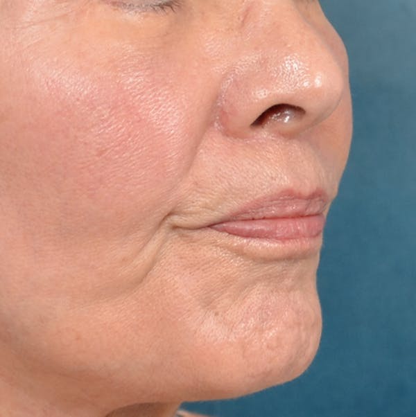 Lip Lift Before & After Gallery - Patient 141138492 - Image 8