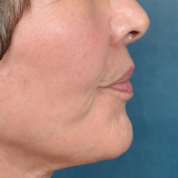 Lip Lift Before & After Gallery - Patient 141138492 - Image 10