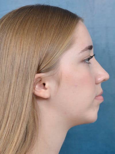 Chin Augmentation Before & After Gallery - Patient 141138500 - Image 6