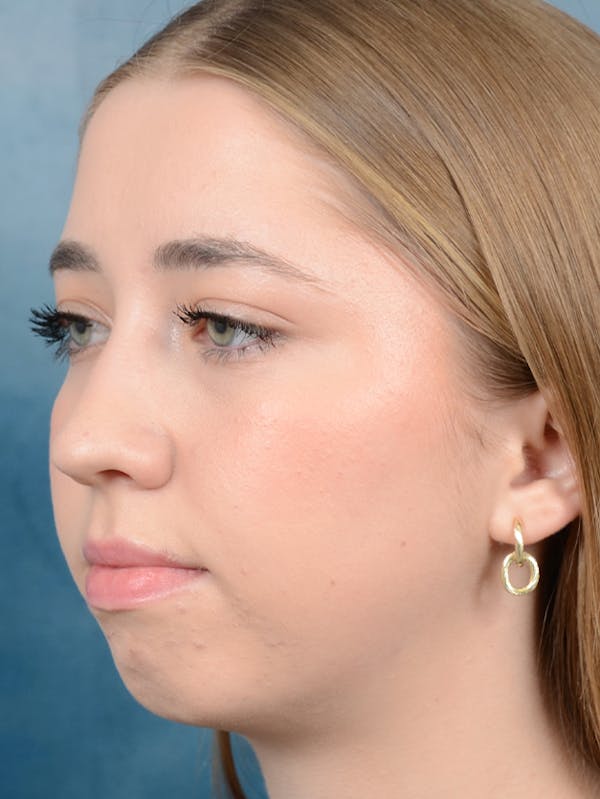 Chin Augmentation Before & After Gallery - Patient 141138500 - Image 7