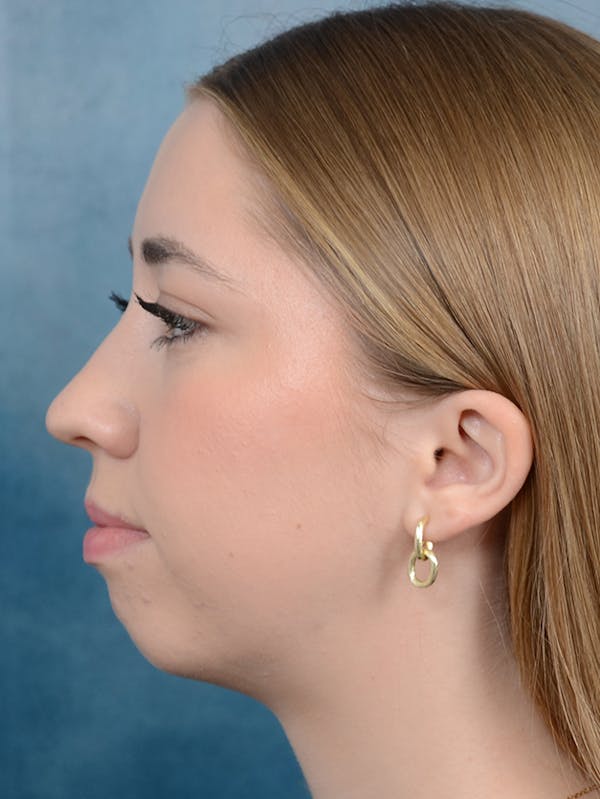 Chin Augmentation Before & After Gallery - Patient 141138500 - Image 9