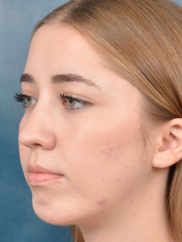 Chin Augmentation Before & After Gallery - Patient 141138500 - Image 8