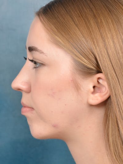 Chin Augmentation Before & After Gallery - Patient 141138500 - Image 10