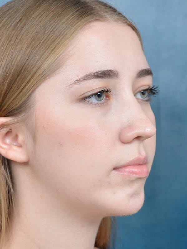 Neck Liposuction Before & After Gallery - Patient 141185044 - Image 4