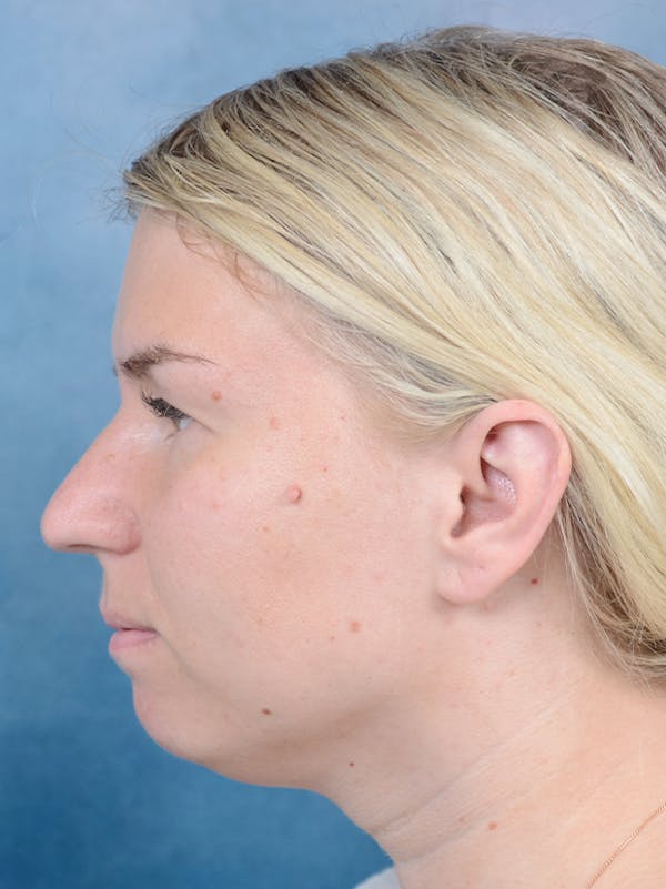 Deep Neck Lift Before & After Gallery - Patient 143507931 - Image 9