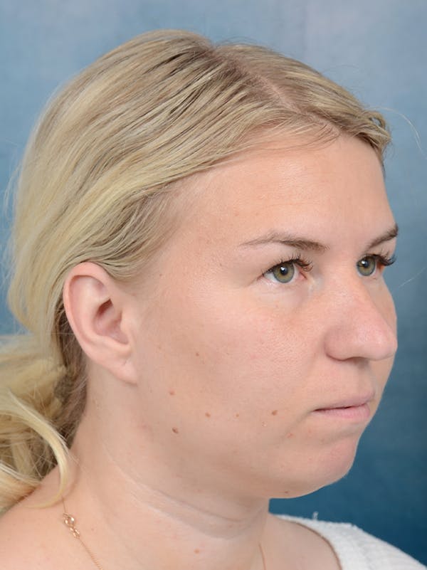 Neck Liposuction Before & After Gallery - Patient 141524176 - Image 3