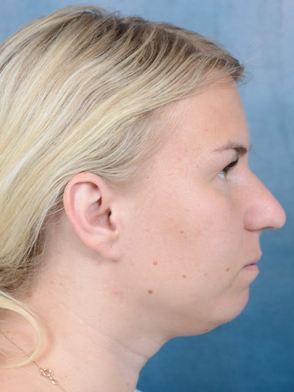 Deep Neck Lift Before & After Gallery - Patient 143507931 - Image 5