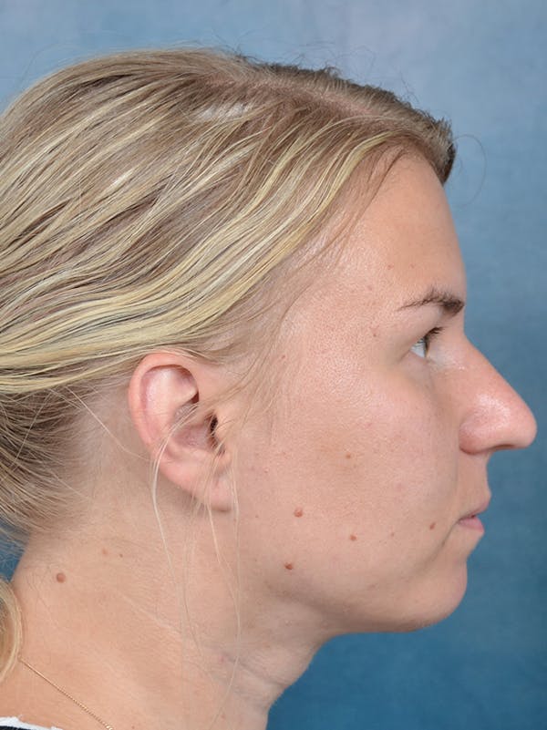 Neck Liposuction Before & After Gallery - Patient 141524176 - Image 6