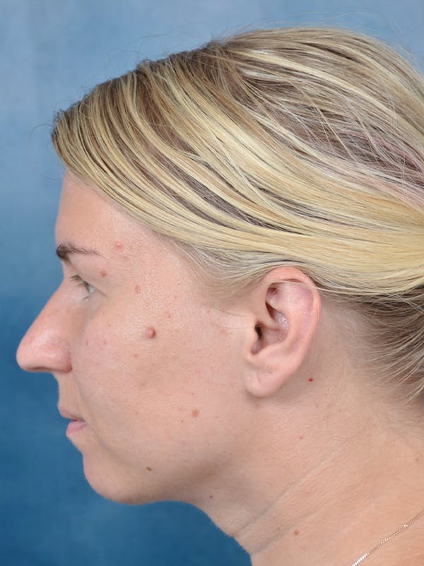 Deep Neck Lift Before & After Gallery - Patient 143507931 - Image 10
