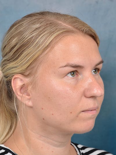 Neck Liposuction Before & After Gallery - Patient 141524176 - Image 4