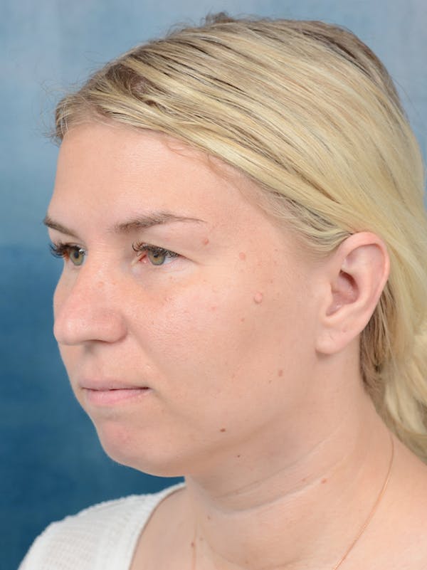 Neck Liposuction Before & After Gallery - Patient 141524176 - Image 7