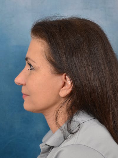 Deep Plane Facelift Before & After Gallery - Patient 141525391 - Image 6