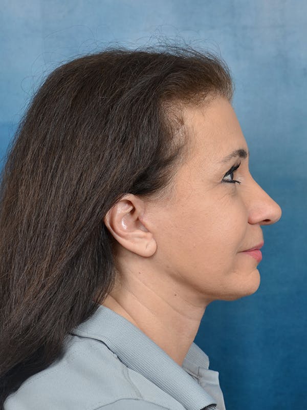 Deep Plane Facelift Before & After Gallery - Patient 141525391 - Image 10