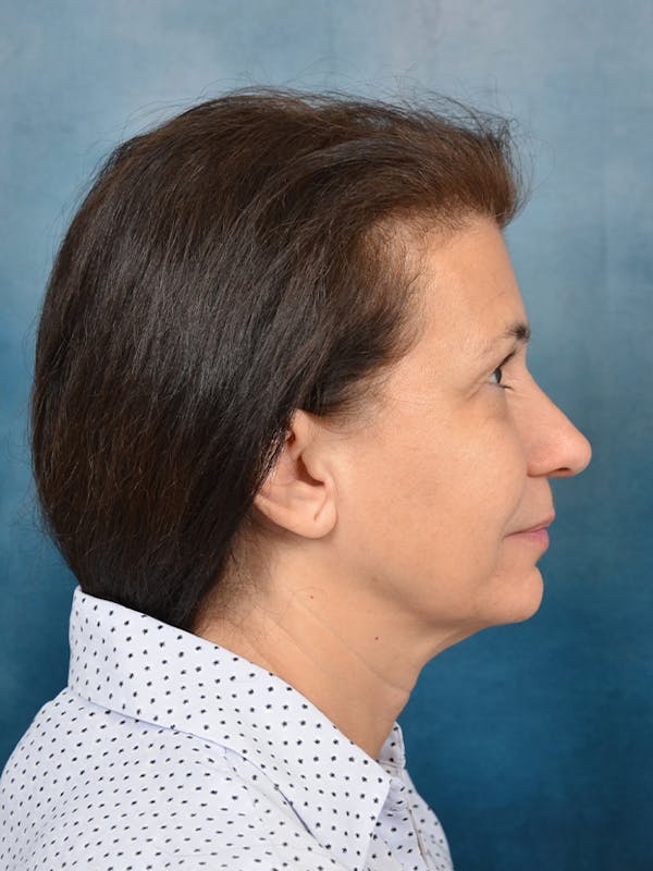 Deep Plane Facelift Before & After Gallery - Patient 141525391 - Image 9