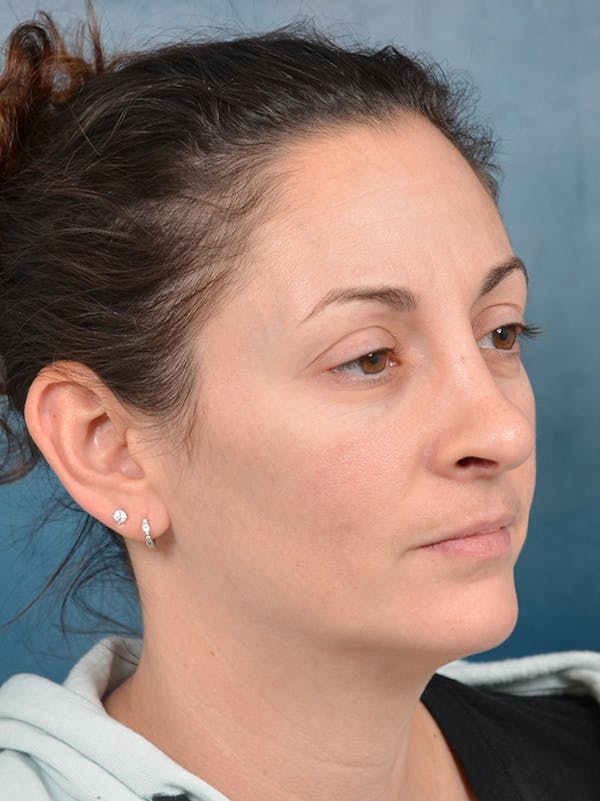 Rhinoplasty Before & After Gallery - Patient 141525437 - Image 8