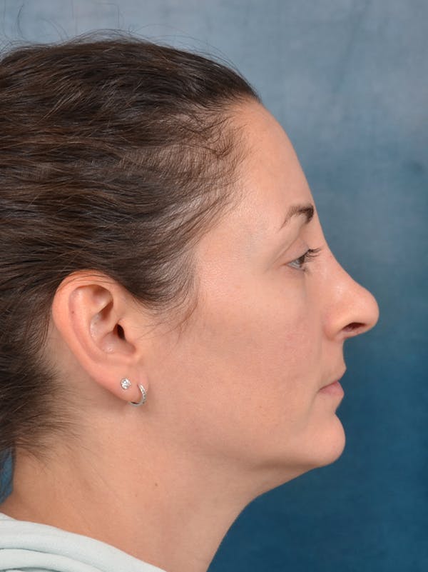 Rhinoplasty Before & After Gallery - Patient 141525437 - Image 10