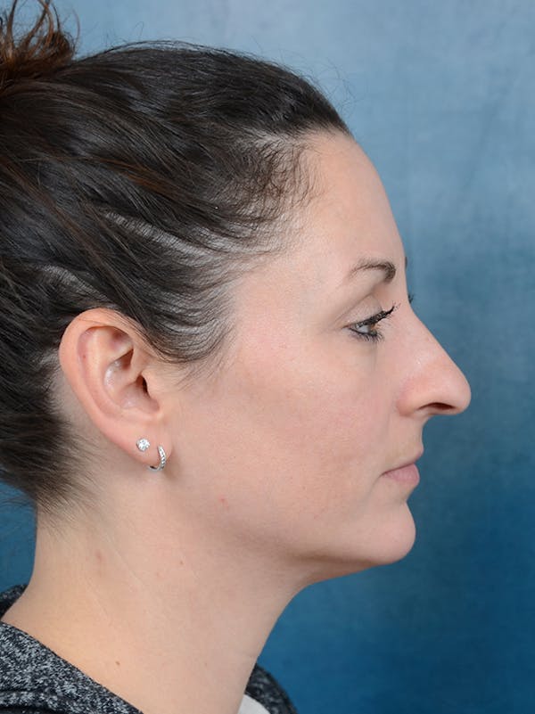 Rhinoplasty Before & After Gallery - Patient 141525437 - Image 9