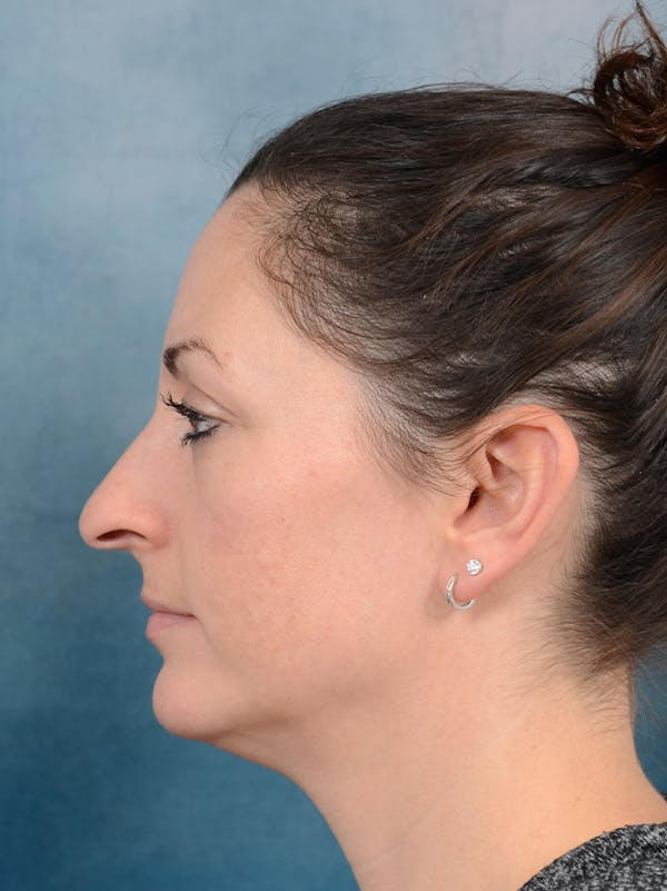 Rhinoplasty Before & After Gallery - Patient 141525437 - Image 1