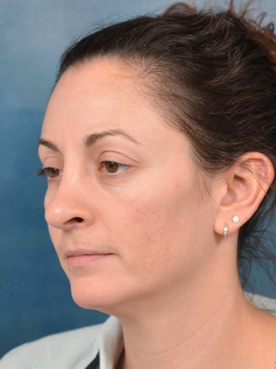 Rhinoplasty Before & After Gallery - Patient 141525437 - Image 4