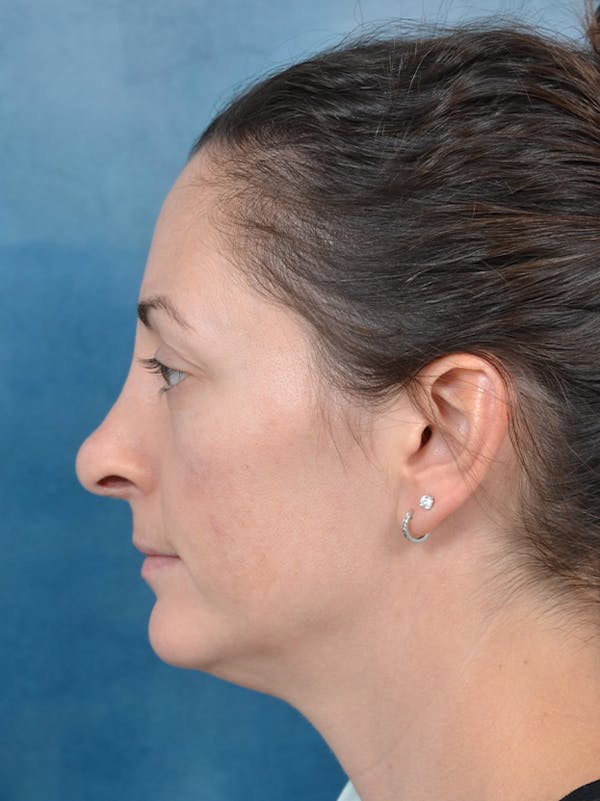 Rhinoplasty Before & After Gallery - Patient 141525437 - Image 2