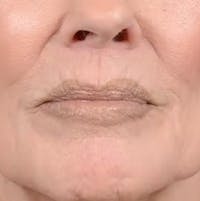 Lip Lift Before & After Gallery - Patient 123886460 - Image 1