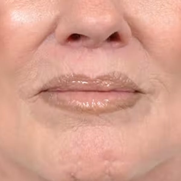Lip Lift Before & After Gallery - Patient 123886460 - Image 2