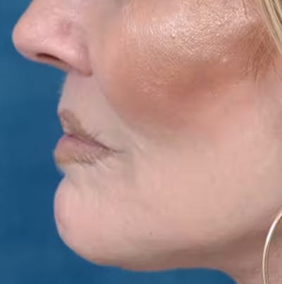 Lip Lift Before & After Gallery - Patient 123886460 - Image 6