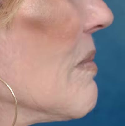 Lip Lift Before & After Gallery - Patient 123886460 - Image 8