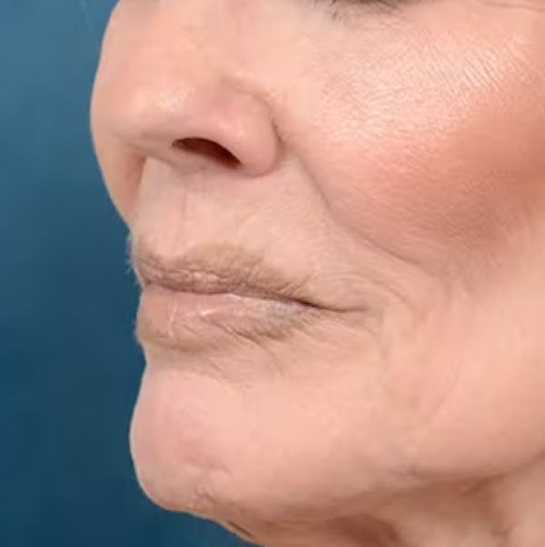 Lip Lift Before & After Gallery - Patient 123886460 - Image 3