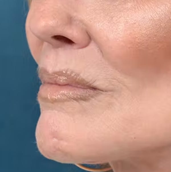 Lip Lift Before & After Gallery - Patient 123886460 - Image 4
