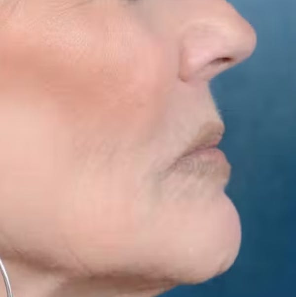 Lip Lift Before & After Gallery - Patient 123886460 - Image 7