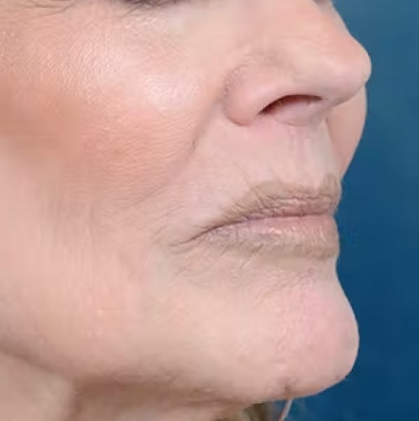 Lip Lift Before & After Gallery - Patient 123886460 - Image 9