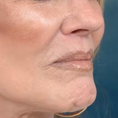 Lip Lift Before & After Gallery - Patient 123886460 - Image 10