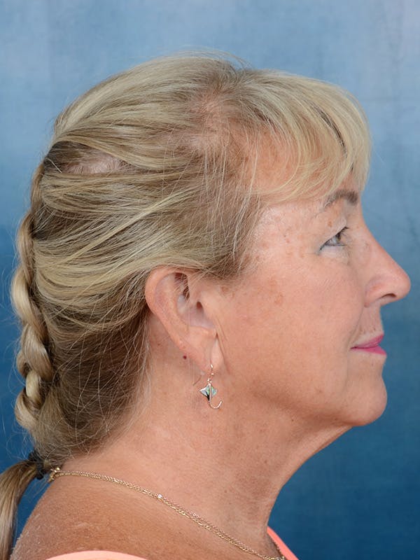 Deep Plane Facelift Before & After Gallery - Patient 142680785 - Image 7
