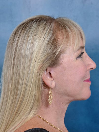 Laser Skin Resurfacing Before & After Gallery - Patient 142680787 - Image 6