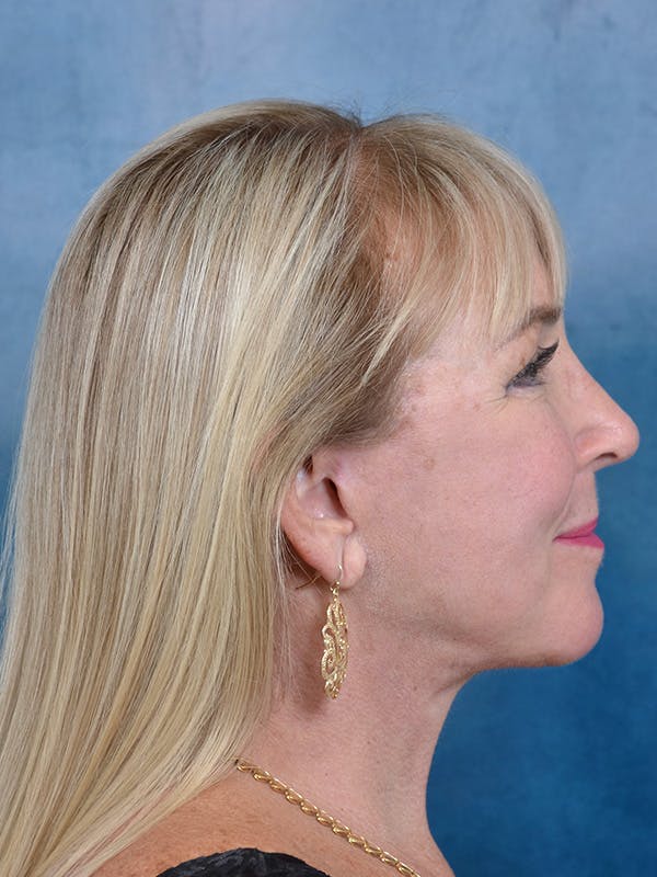 Deep Plane Facelift Before & After Gallery - Patient 142680785 - Image 8