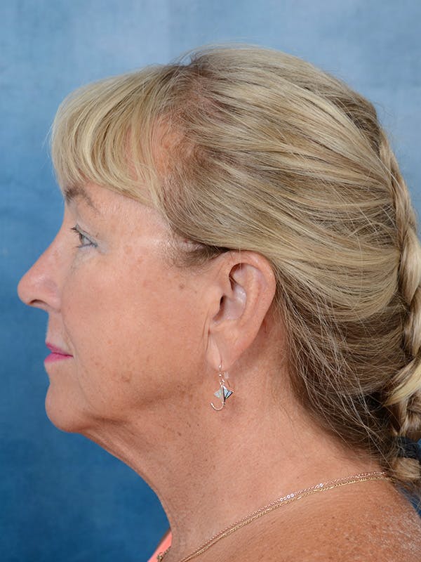 Deep Plane Facelift Before & After Gallery - Patient 142680785 - Image 9